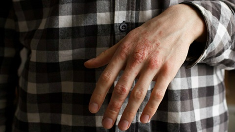 psoriasis